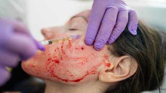 3 women diagnosed with HIV after getting ‘vampire facials’ at unlicensed spa