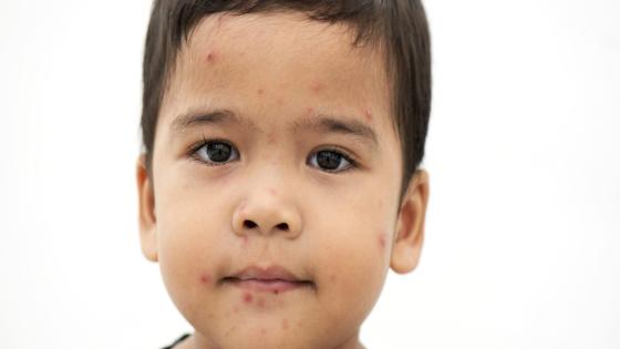 Measles is highly contagious. Here’s how to protect yourself