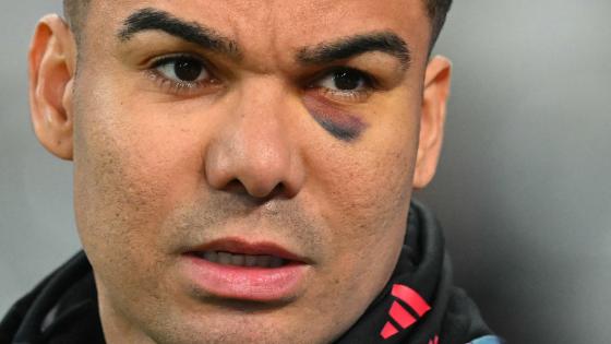 Why does Casemiro have a black eye for Man Utd?