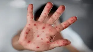 New mpox variant detected in Germany: health authority
